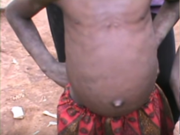 Cases Of Bilharzia On The Rise Among Mayuge’s Children