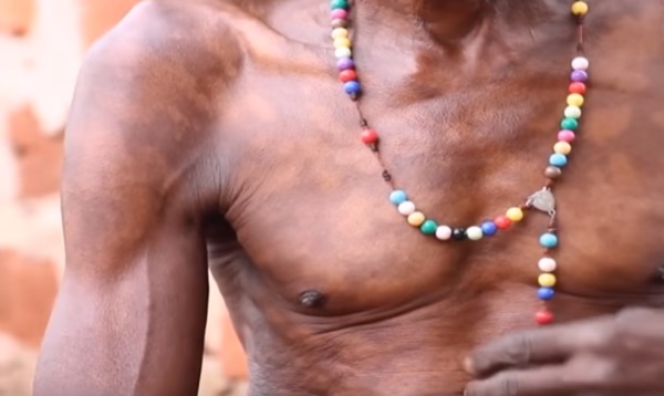 Leprosy On Te Rise In Luweero District, With 50 Cases Reported